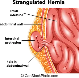 Hernia surgery